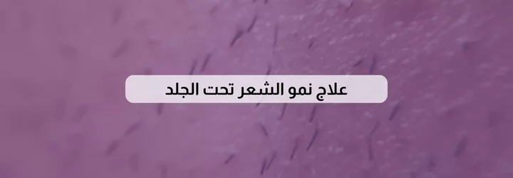 علاج نمو الشعر تحت الجلد 1