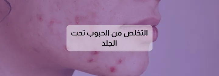 التخلص من الحبوب تحت الجلد 2 التخلص من الحبوب تحت الجلد 1