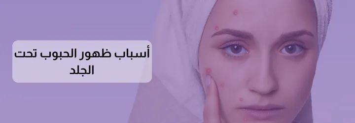التخلص من الحبوب تحت الجلد 3 التخلص من الحبوب تحت الجلد
